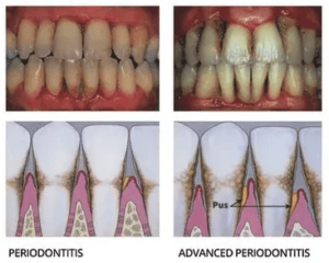 Example of Periodontitis and Advanced Periodontitis