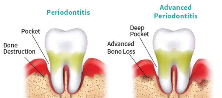 Periodontitis and Advanced Periodontitis