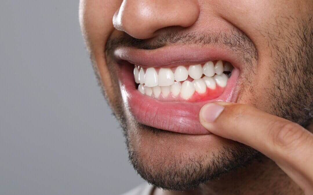 What Happens After Gum Disease Treatment